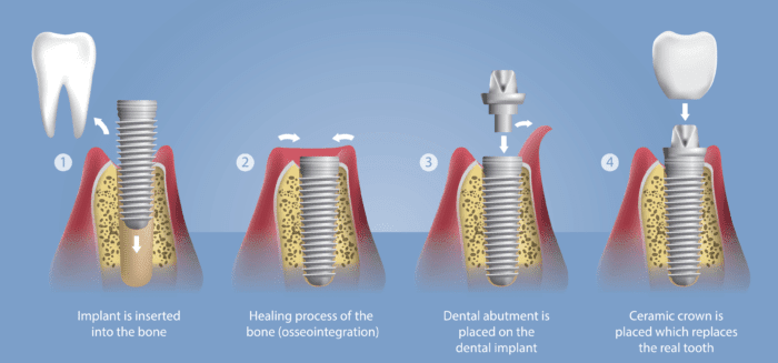 Root Canal