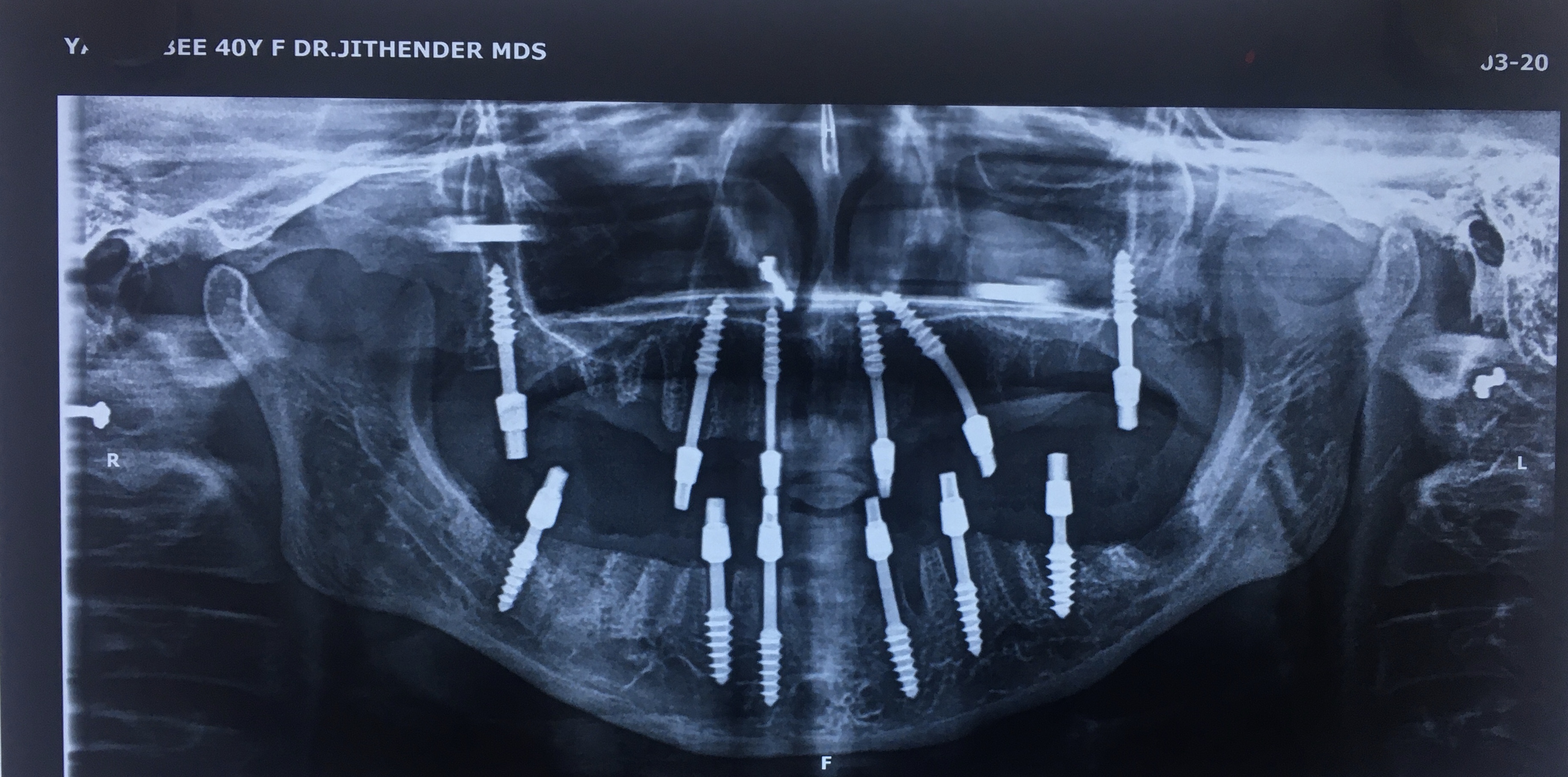 Bicortical Implants