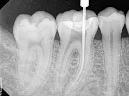 Root Canal Treatment Services