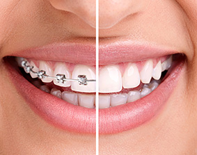 Root Canal
