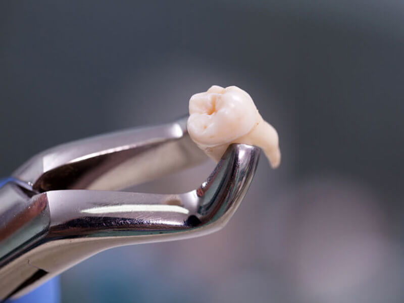 Root Canal